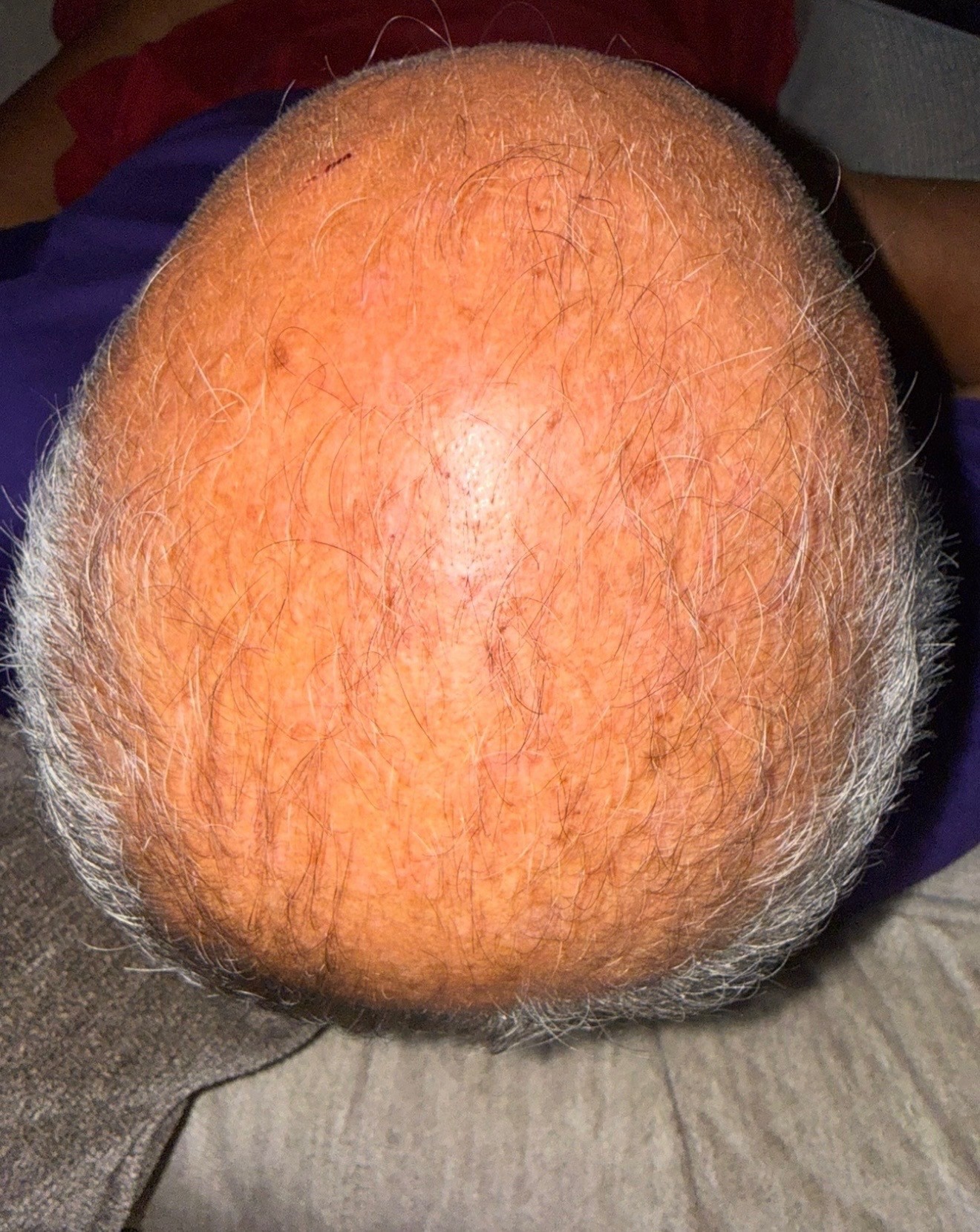Hair restoration patient progress, month 1