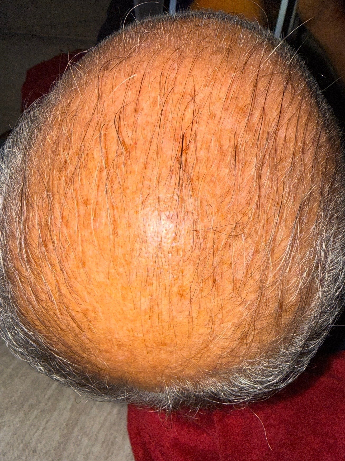 Hair restoration patient progress, month 2
