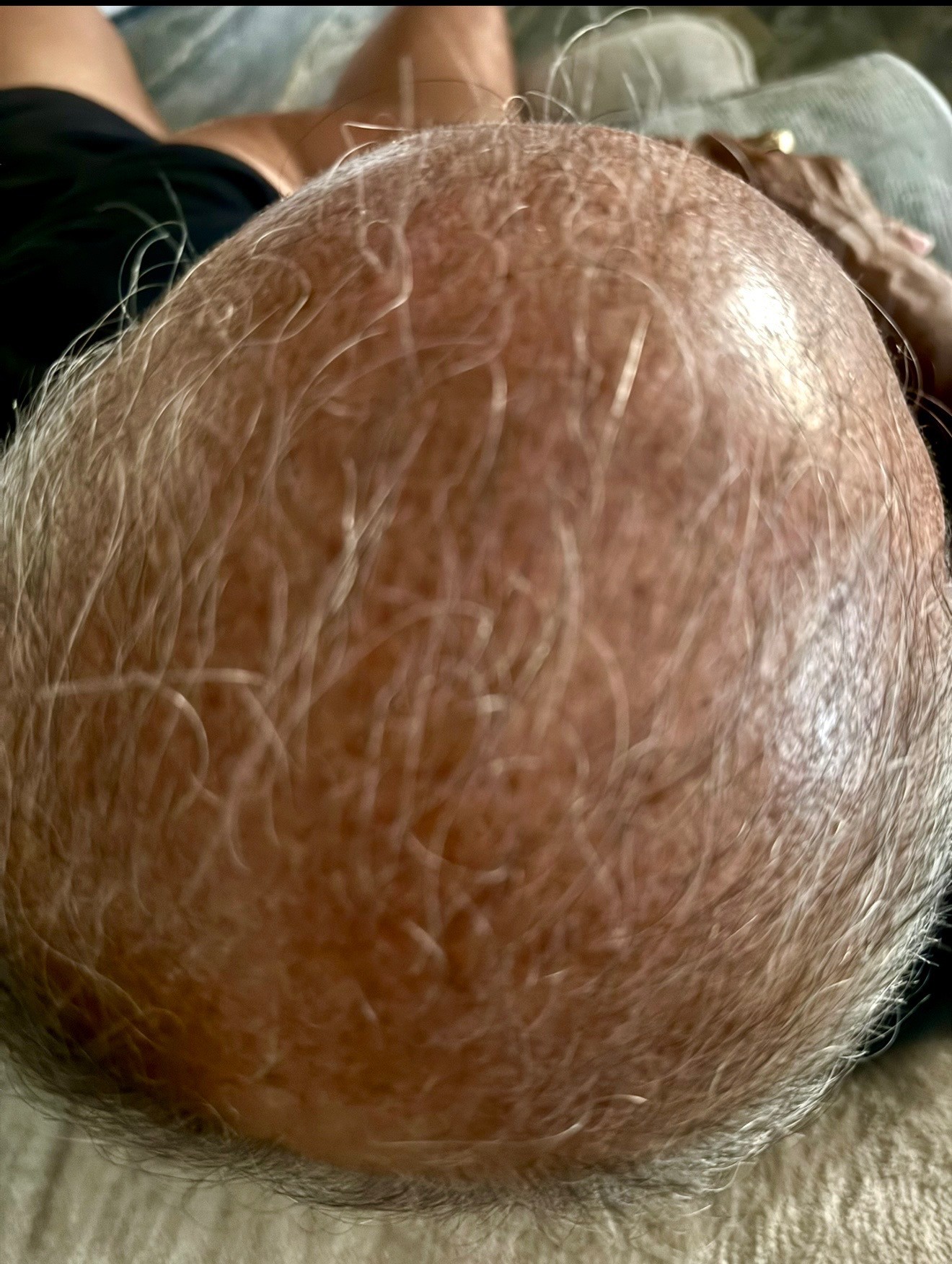 Hair restoration patient progress, month 3